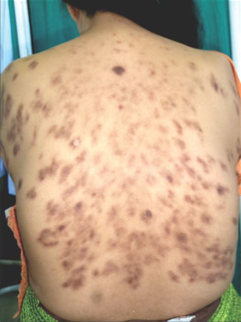 Kuvatulokset haulle castleman s disease specialist