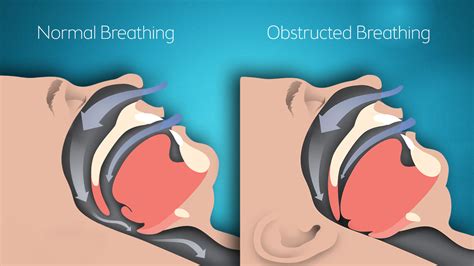 Image result for Obstructive Sleep Apnea