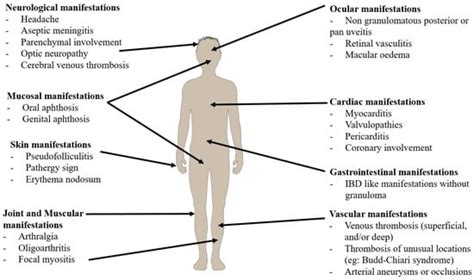 Behçet’s Disease Uveitis
