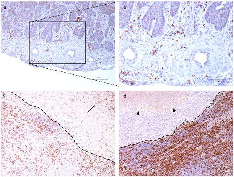 From Tumor Macroenvironment to Tumor Microenvironment: The Prognostic ...
