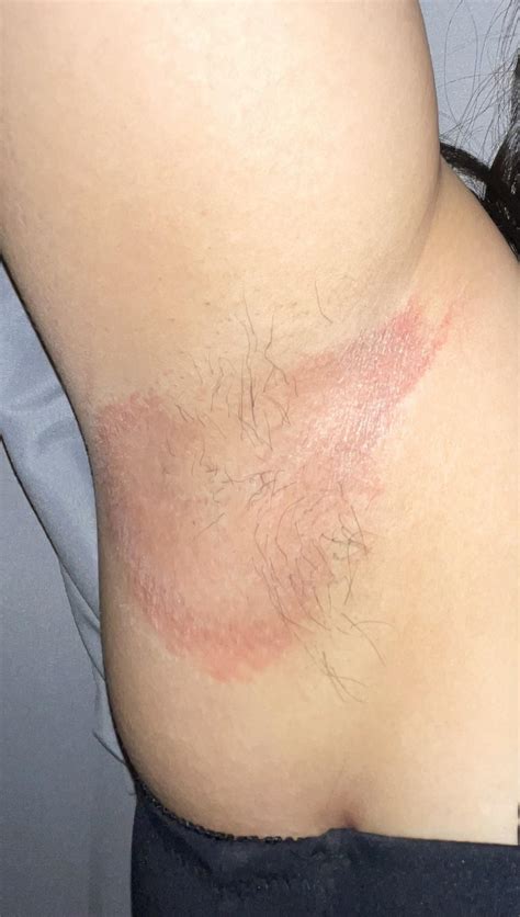 Rash on my armpit. Fungal infection or contact dermatitis? : r/Dermatology
