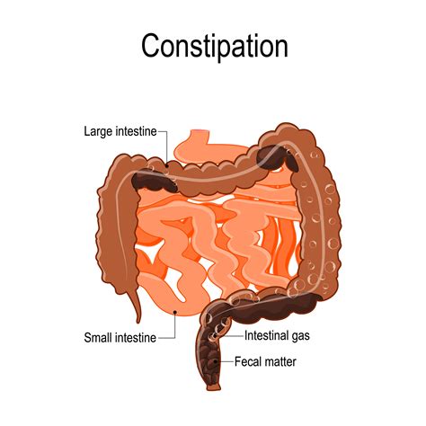 Constipation Treatment Atlanta GA - Costiveness Atlanta GA