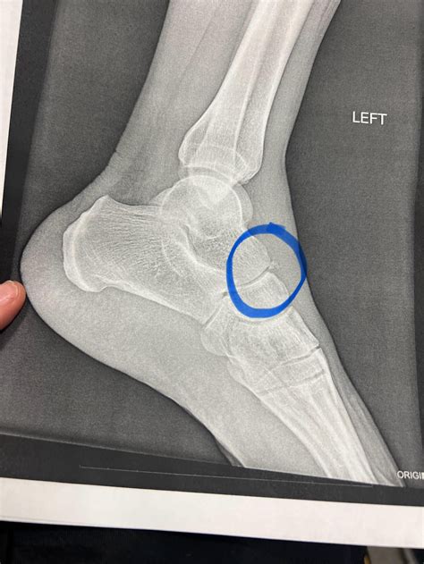 Navicular Bone Fracture Boot at Lucy Doak blog