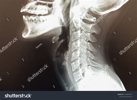 Normal Female Cervical Spine Mri