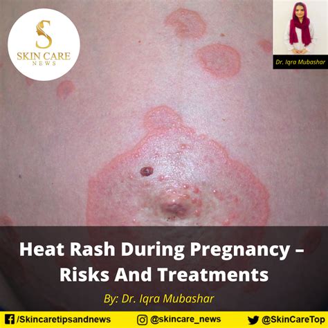 Heat Rash During Pregnancy – Risks And Treatments