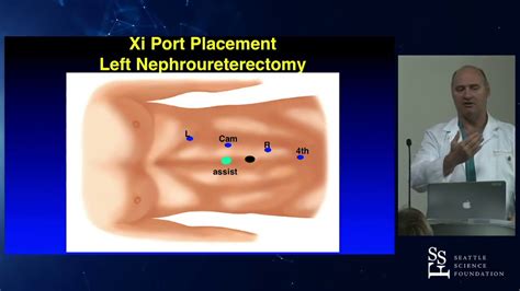 Image result for Nephrectomy Positioning