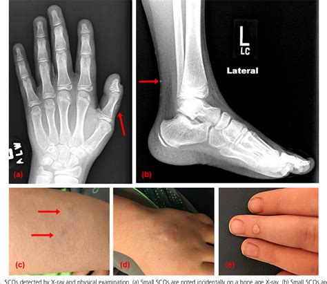 Figure 1 from Ossifications in Albright Hereditary Osteodystrophy: Role ...