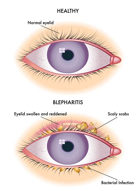 Blepharitis (Swollen Eyelids): Symptoms, Causes & Treatment
