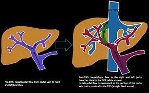 Image result for intrahepatic