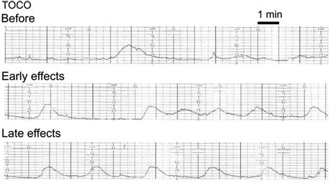 Monitoring uterine contractions during labor: current challenges and future directions ...