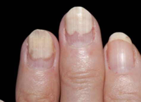 melanoma and gel nails