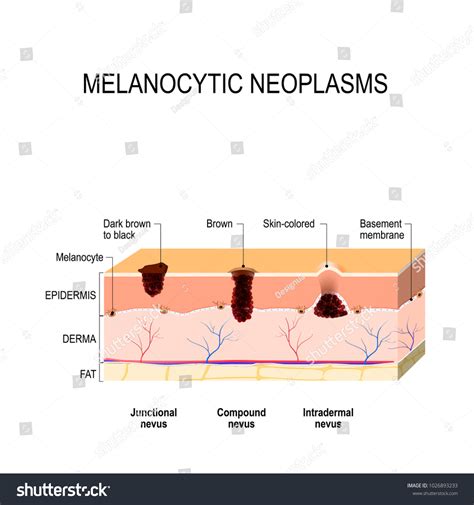 Melanocytic Nevus Junctional Compound Intradermal Nevus: ilustración de ...