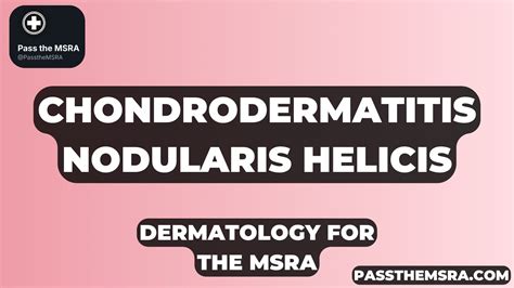 Chondrodermatitis Nodularis Helicis MSRA Revision – Notes, Flashcards ...