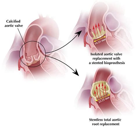 Late Outcomes Following Freestyle Versus Homograft Aortic Root Replacement: Results From a ...