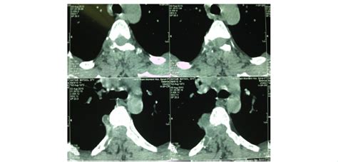 Image result for Effect CT Scan