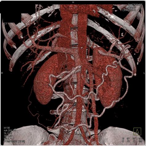 Adenocarcinoma Pancreas - Pancreas Radiology Case Studies - CTisus CT ...