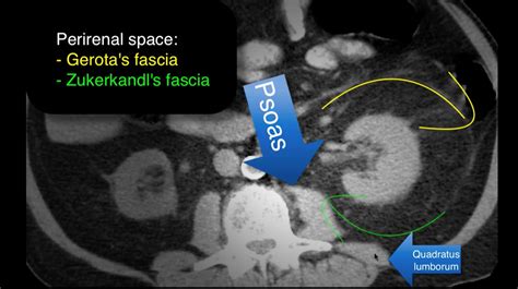 Ct Anatomy Of Renal Fascia at Oscar Godson blog