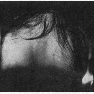 Image result for Transillumination Normal Head