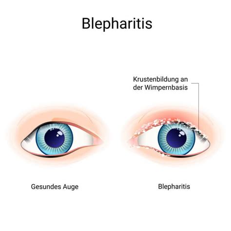 Bildergebnis für blepharitis ansteckend