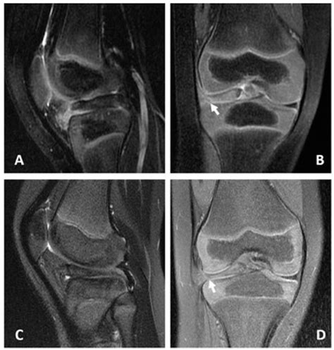 Bucket Handle Tear Lateral Meniscus Repair at Kristian Christenson blog