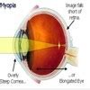 What are Defects of vision? - Brainly.in