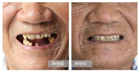 75岁怕痛老人种牙15颗_广州德伦口腔