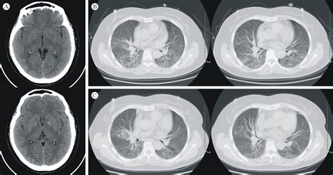 影像入门必备：这 6 种胸部 CT 征象最常见