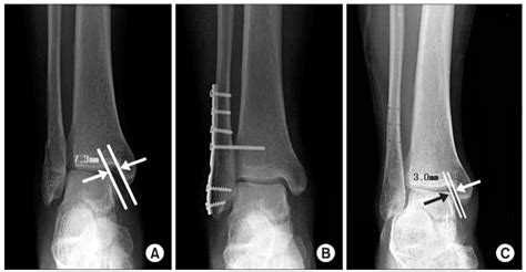 Treatment of Lateral Malleolar Fracture Associated with Disruption of ...