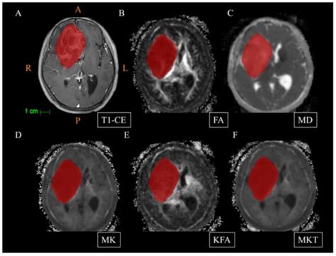 Machine Learning Based on Diffusion Kurtosis Imaging Histogram ...