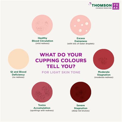 What is Cupping and How Does it Work? — MOONFLOWER Acupuncture & Herbal Medicine