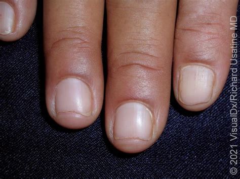 Iron Deficiency Anemia | VisualDx