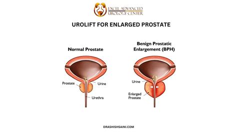 Image result for Problems After UroLift