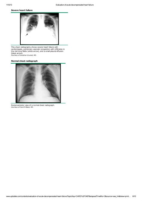 Evaluation of acute decompensated heart failure2 | PDF