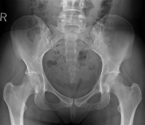 X-ray of Normal Pelvis (Female) | Eccles Health Sciences Library | J ...