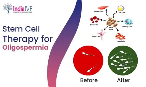 Stem Cell Therapy for Oligospermia | India IVF Fertility Clinic