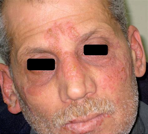 Hsv Disseminated Disease