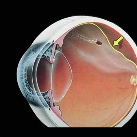 Qué hacer antes de una operación de desprendimiento de retina. Cuidados tras la cirugía de ...