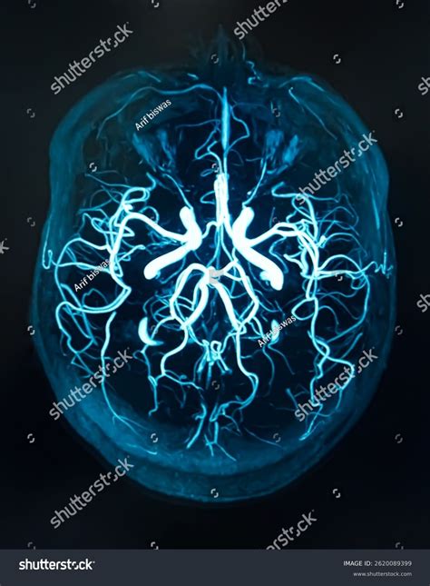 Mrv Brain Magnetic Resonance Venography Brain Stock Illustration 2620089399 | Shutterstock