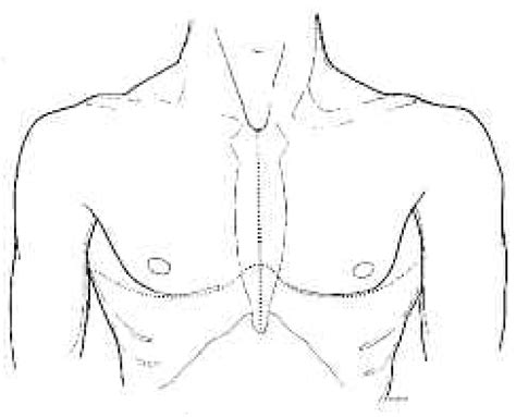 Image result for Clamshell Procedure