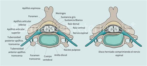 Hernia discal en perros y gatos: síntomas, tratamiento y pronóstico ...
