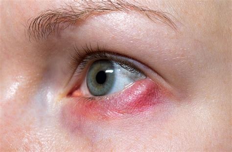 Blepharitis vs Styes: What are the Differences? | Vaughan