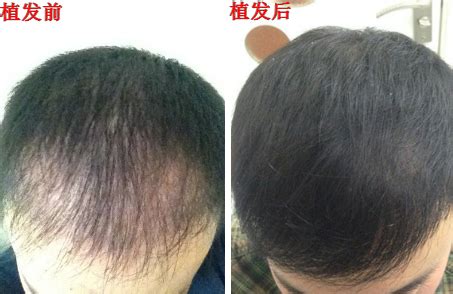 hair transplant: pang zongmei, adjusting hairline photos_Plastic ...