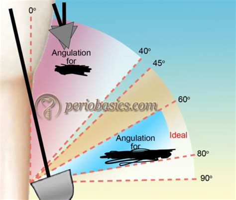 calculus removal stroke Flashcards | Quizlet