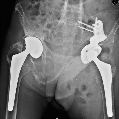 Symptoms Of Osteolysis