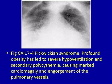 17 high output heart disease | PPTX