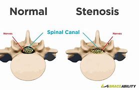 stenosis 的图像结果