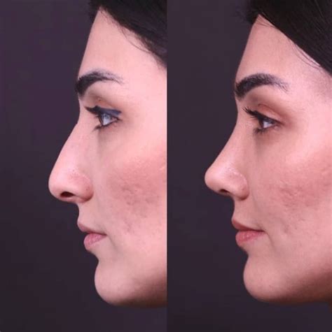 Pin by Medipars on Rhinoplasty before after 2020 | Nose plastic surgery, Rhinoplasty nose jobs ...