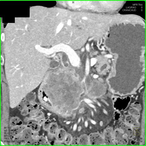 Pancreatic Adenocarcinoma - Pancreas Radiology Case Studies - CTisus CT ...