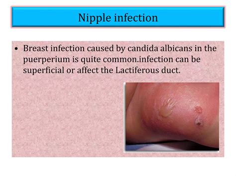 Breast Complications | PPTX