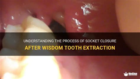 Tooth Socket After Extraction 的图像结果